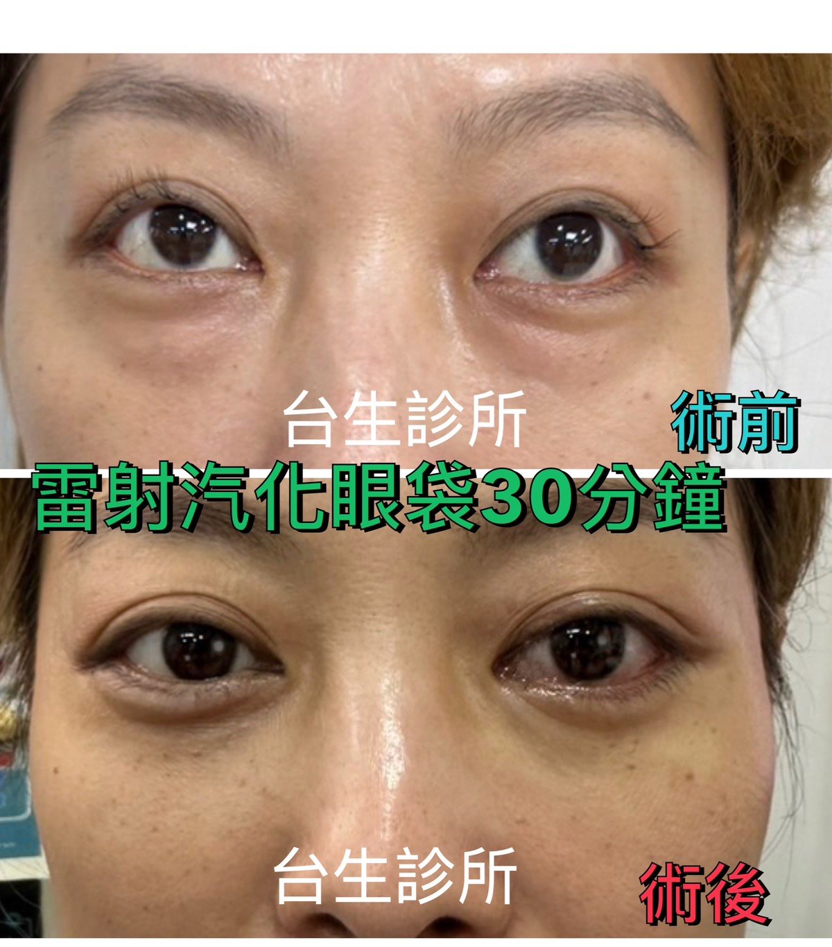 30分鐘無痛雷射汽化眼袋術後效果 - 