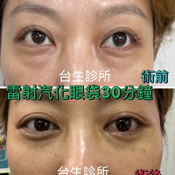 30分鐘無痛雷射汽化眼袋術後效果 - 