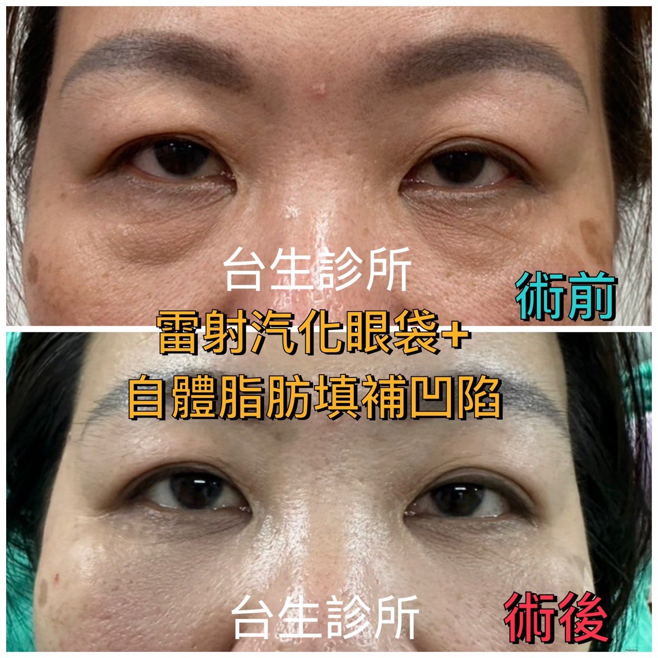 恢復年輕擺脫老態~30分鐘雷射汽化眼袋+3D自體脂肪填補淚溝黑眼圈 - 