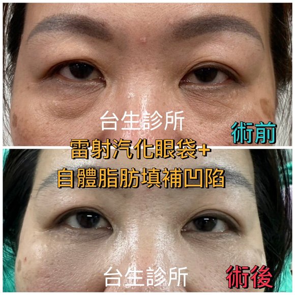 恢復年輕擺脫老態~30分鐘雷射汽化眼袋+3D自體脂肪填補淚溝黑眼圈 - 