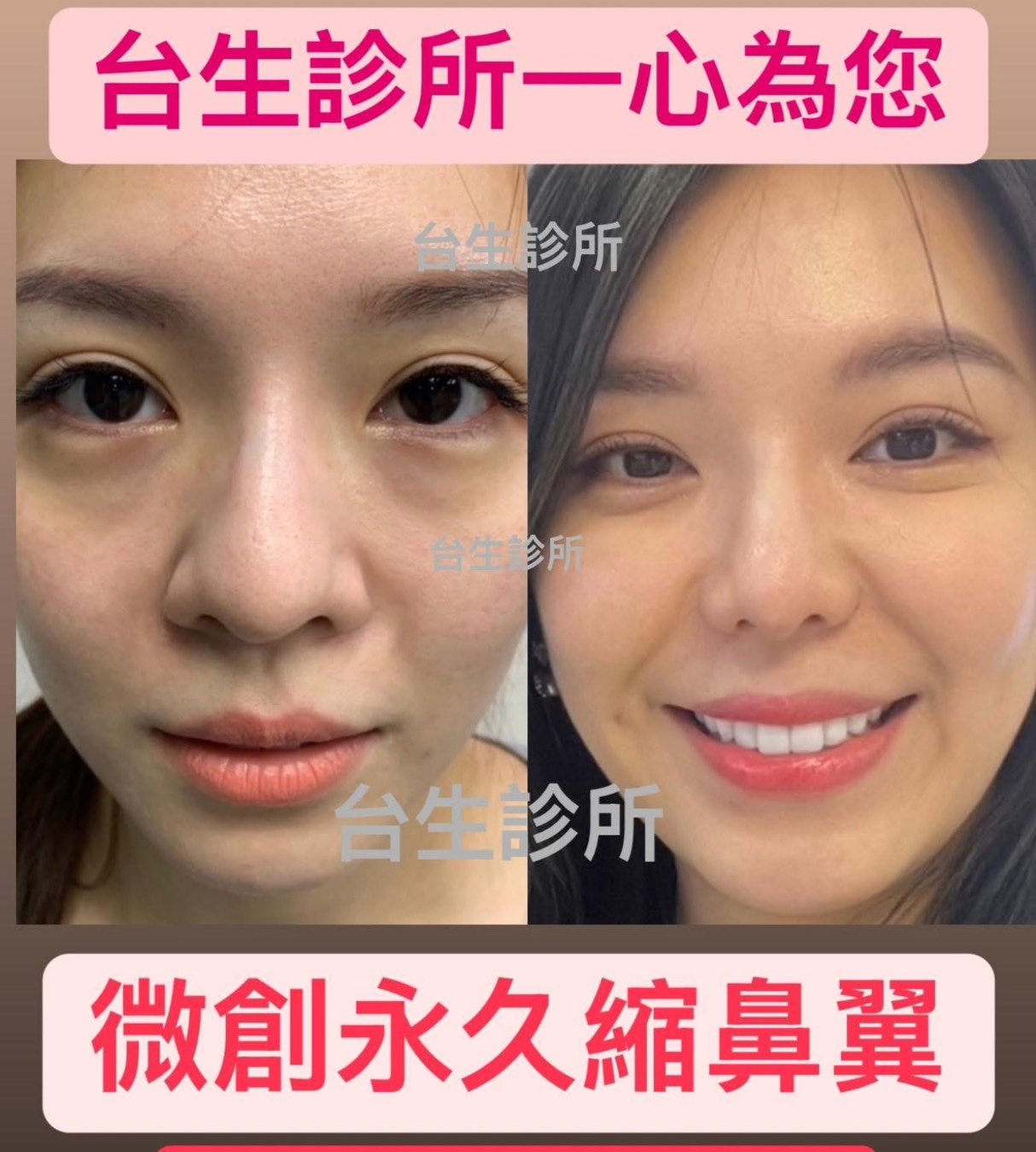 30分鐘微創永久縮鼻翼效果 - 