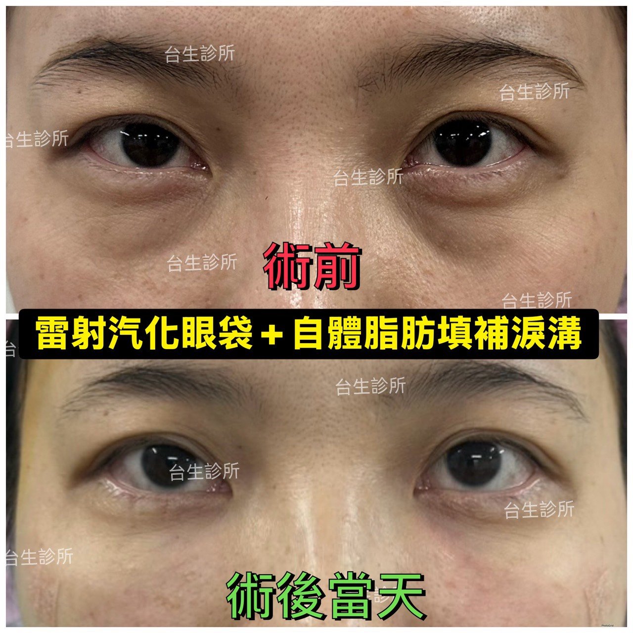 老態去除~30分鐘雷射汽化眼袋+3D自體脂肪填補淚溝黑眼圈 - 