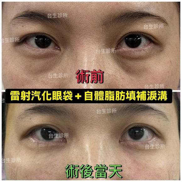 老態去除~30分鐘雷射汽化眼袋+3D自體脂肪填補淚溝黑眼圈 - 