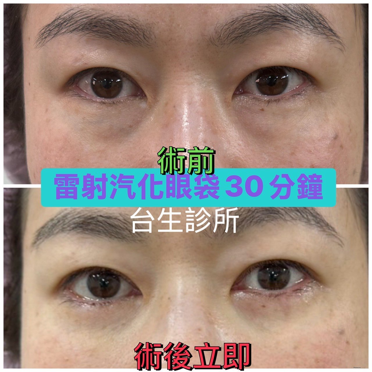 30分鐘無痛雷射汽化眼袋術後立即效果 - 