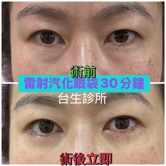 30分鐘無痛雷射汽化眼袋術後立即效果 - 