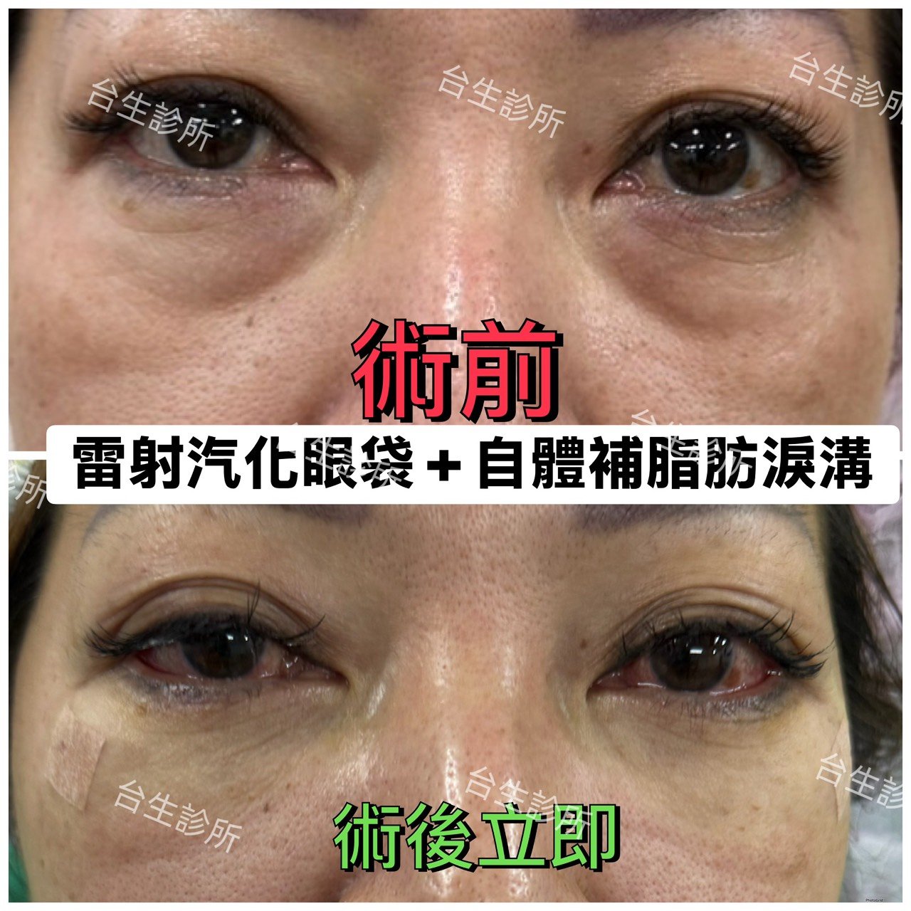 30分鐘雷射汽化眼袋+自體脂肪填補淚溝黑眼圈 - 