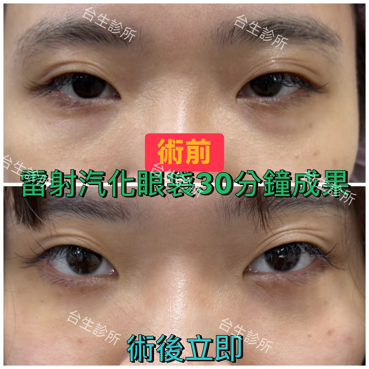 30分鐘無痛雷射汽化眼袋術後立即效果 - 
