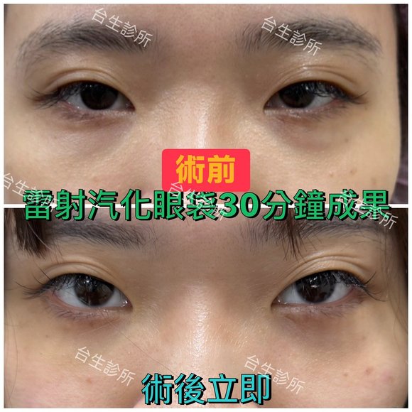 30分鐘無痛雷射汽化眼袋術後立即效果 - 