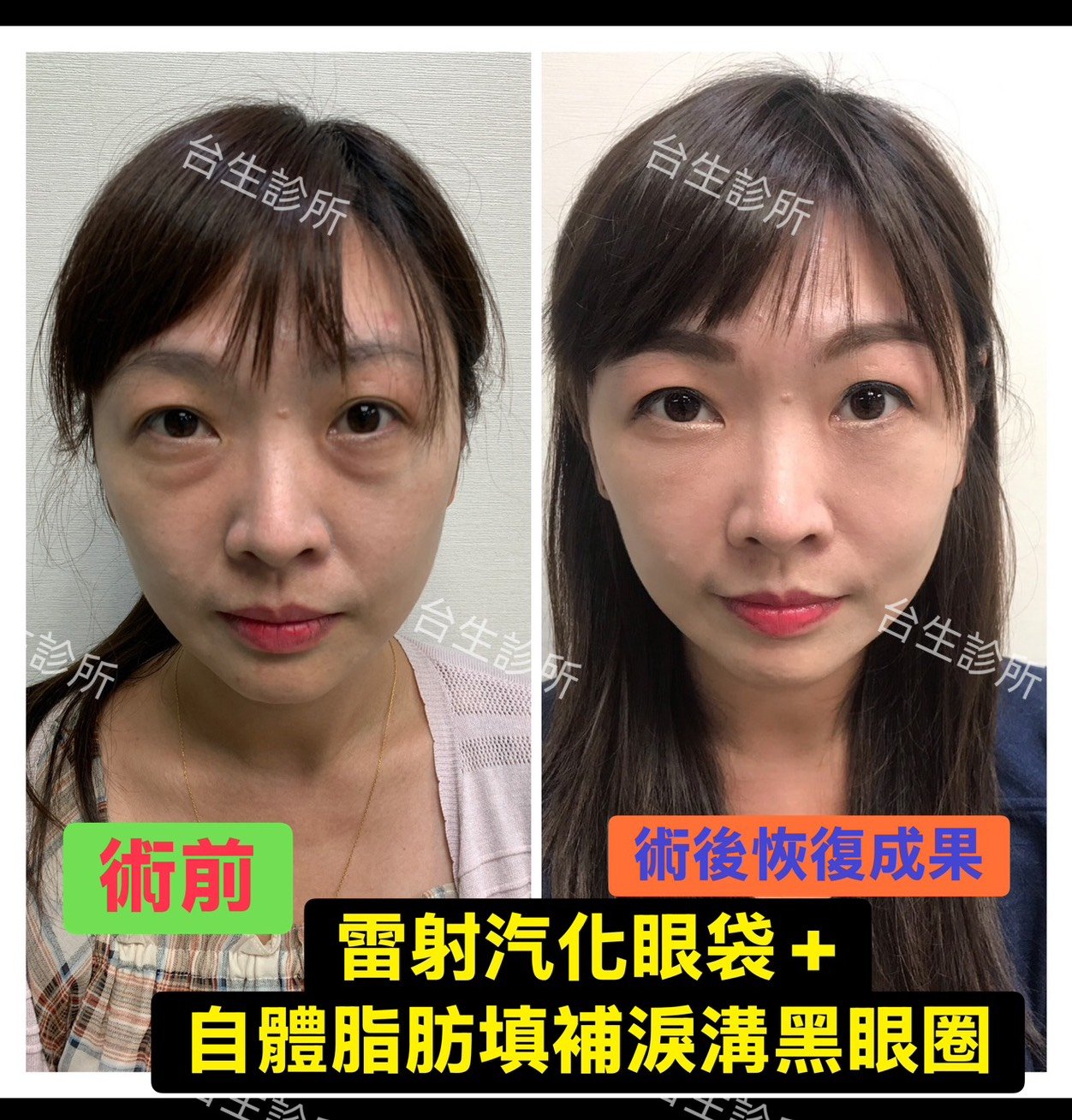恢復年輕擺脫老態~30分鐘雷射汽化眼袋+3D自體脂肪填補淚溝黑眼圈 - 