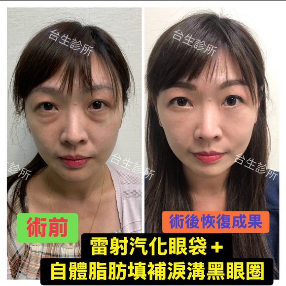 恢復年輕擺脫老態~30分鐘雷射汽化眼袋+3D自體脂肪填補淚溝黑眼圈 - 