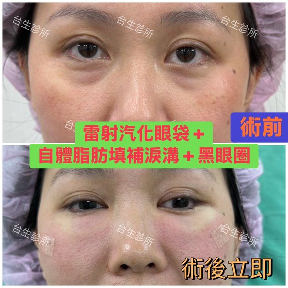 術後立即效果~30分鐘雷射汽化眼袋+自體脂肪填補淚溝黑眼圈 - 