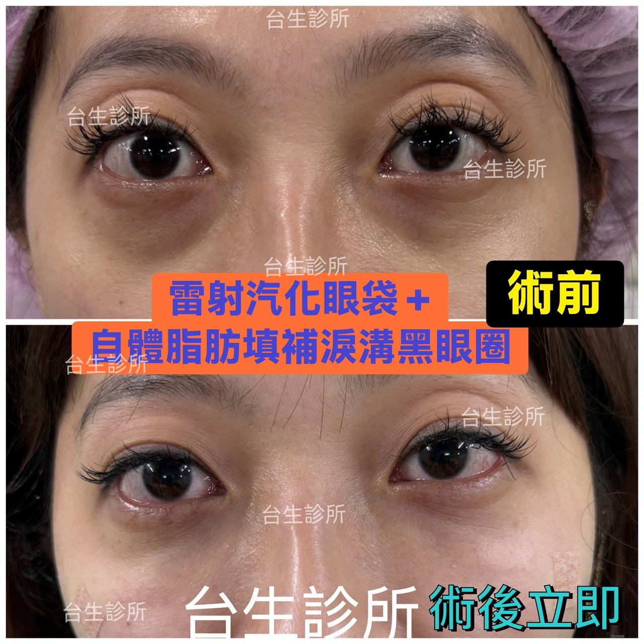 術後立即效果~30分鐘雷射汽化眼袋+自體脂肪填補淚溝黑眼圈 - 