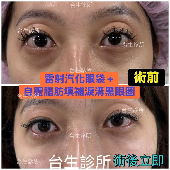 術後立即效果~30分鐘雷射汽化眼袋+自體脂肪填補淚溝黑眼圈 - 