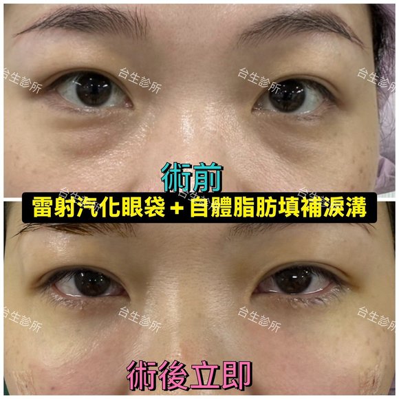 術後立即效果~30分鐘雷射汽化眼袋+自體脂肪填補淚溝黑眼圈 - 
