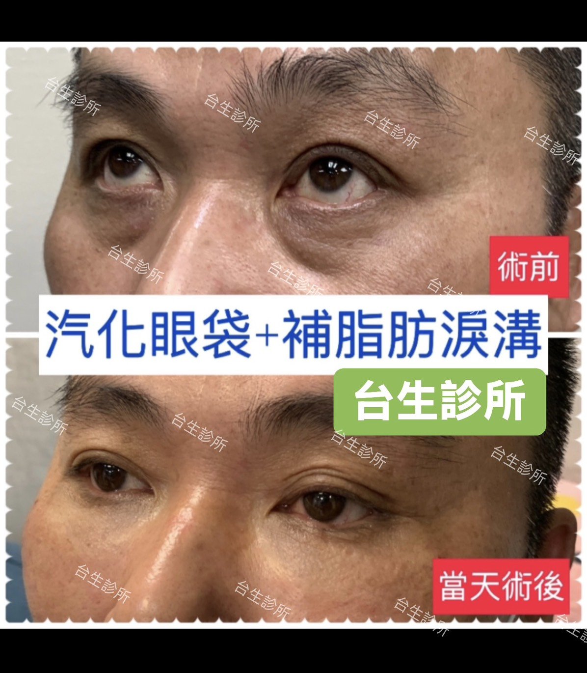 老態去除~30分鐘雷射汽化眼袋+3D自體脂肪填補淚溝黑眼圈 - 