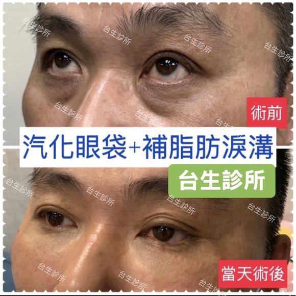 老態去除~30分鐘雷射汽化眼袋+3D自體脂肪填補淚溝黑眼圈 - 
