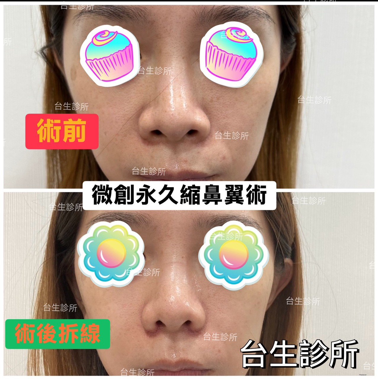 鼻孔變小的手術方式~ 30分鐘微創永久縮鼻翼術 - 