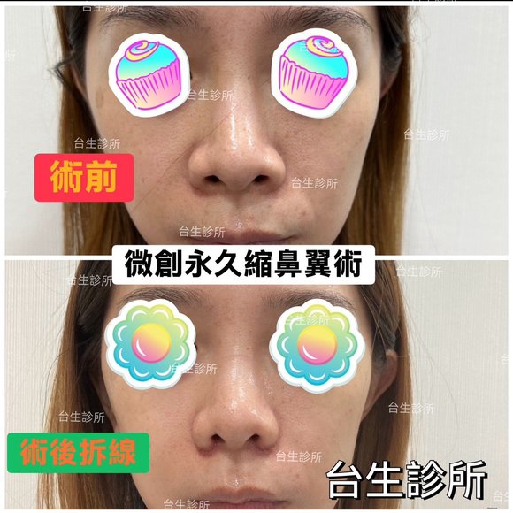 鼻孔變小的手術方式~ 30分鐘微創永久縮鼻翼術 - 