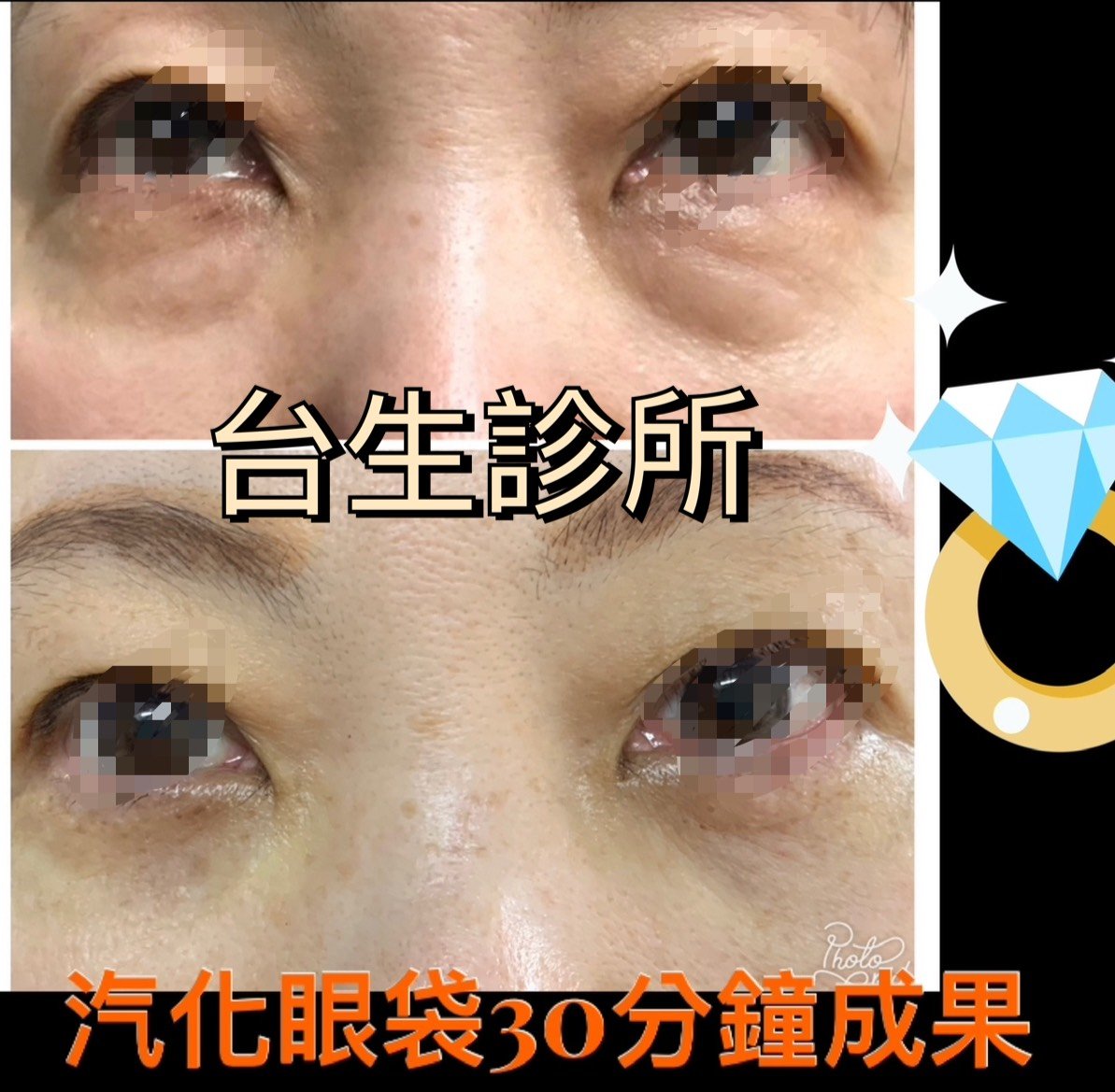 30分鐘無痛雷射汽化眼袋術後效果 - 