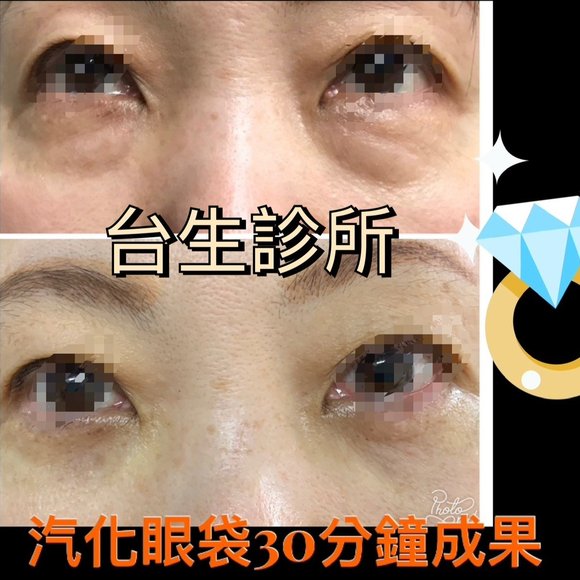 30分鐘無痛雷射汽化眼袋術後效果 - 