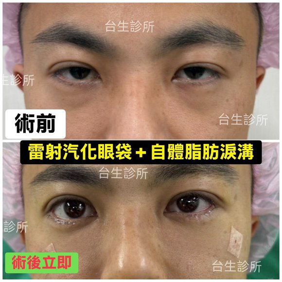 30分鐘雷射汽化眼袋+自體脂肪填補淚溝黑眼圈術後立即效果 - 