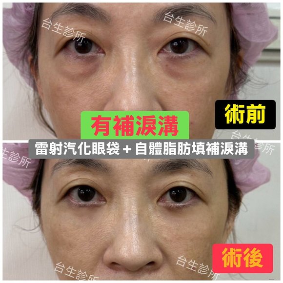 擺脫老態淚溝黑眼圈~30分鐘雷射汽化眼袋+3D自體脂肪填補淚溝黑眼圈 - 