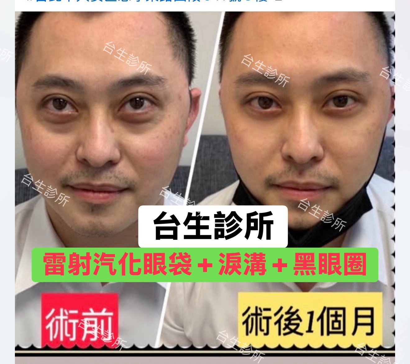 術後一個月~30分鐘雷射汽化眼袋+自體脂肪填補淚溝黑眼圈 - 