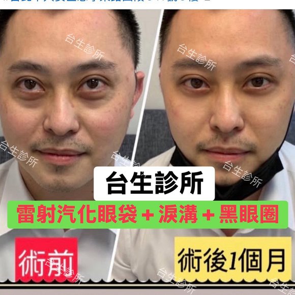 術後一個月~30分鐘雷射汽化眼袋+自體脂肪填補淚溝黑眼圈 - 
