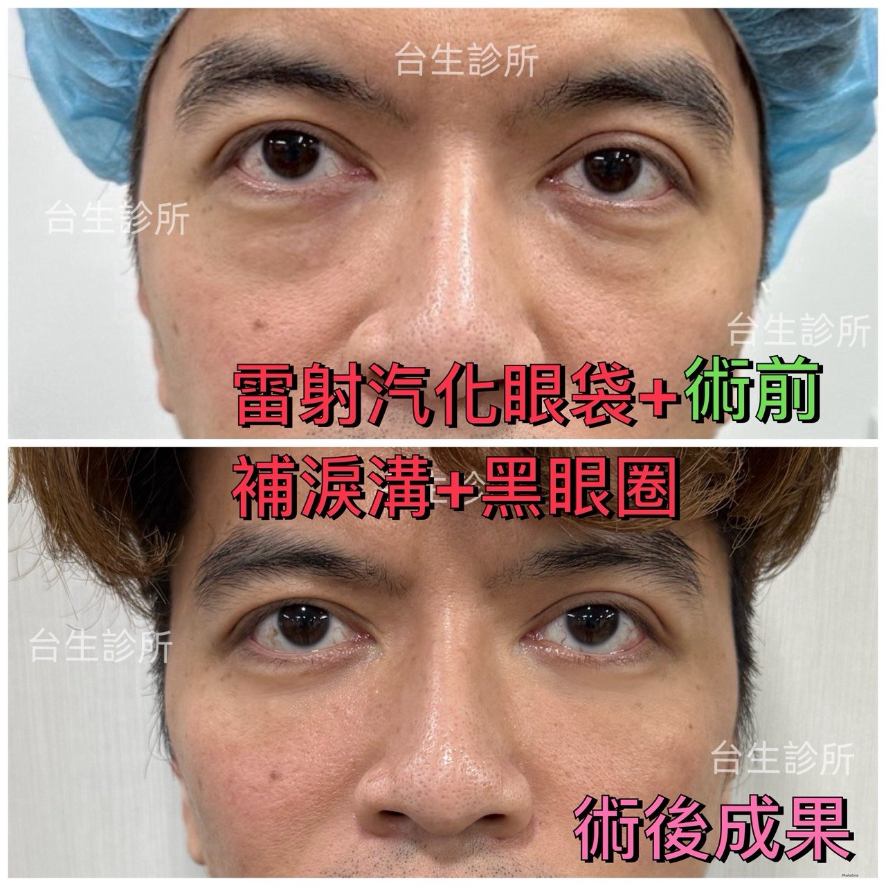 術後成果~30分鐘雷射汽化眼袋+自體脂肪填補淚溝黑眼圈 - 