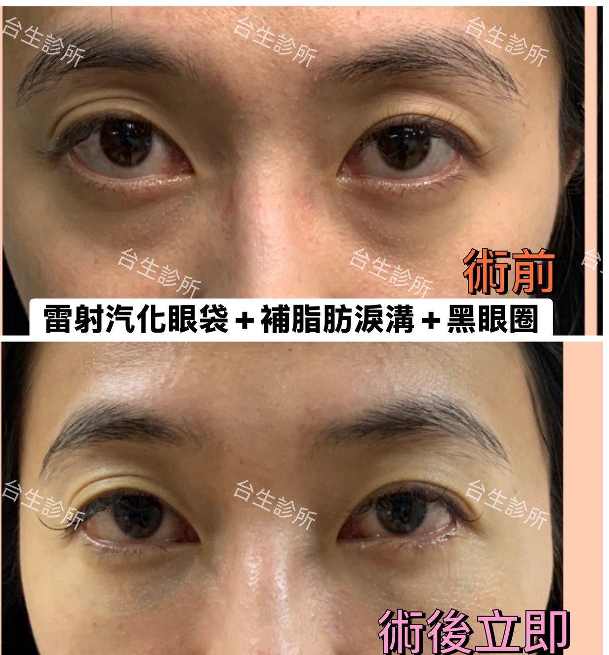 術後立即效果~30分鐘雷射汽化眼袋+自體脂肪填補淚溝黑眼圈 - 