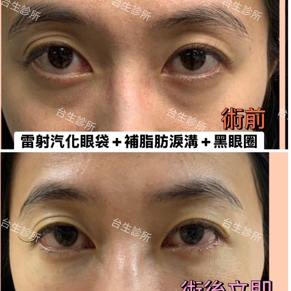 術後立即效果~30分鐘雷射汽化眼袋+自體脂肪填補淚溝黑眼圈 - 