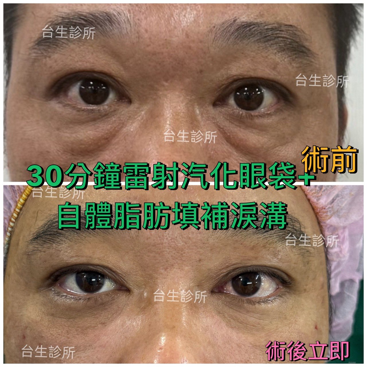 術後立即效果~30分鐘雷射汽化眼袋+自體脂肪填補淚溝黑眼圈 - 