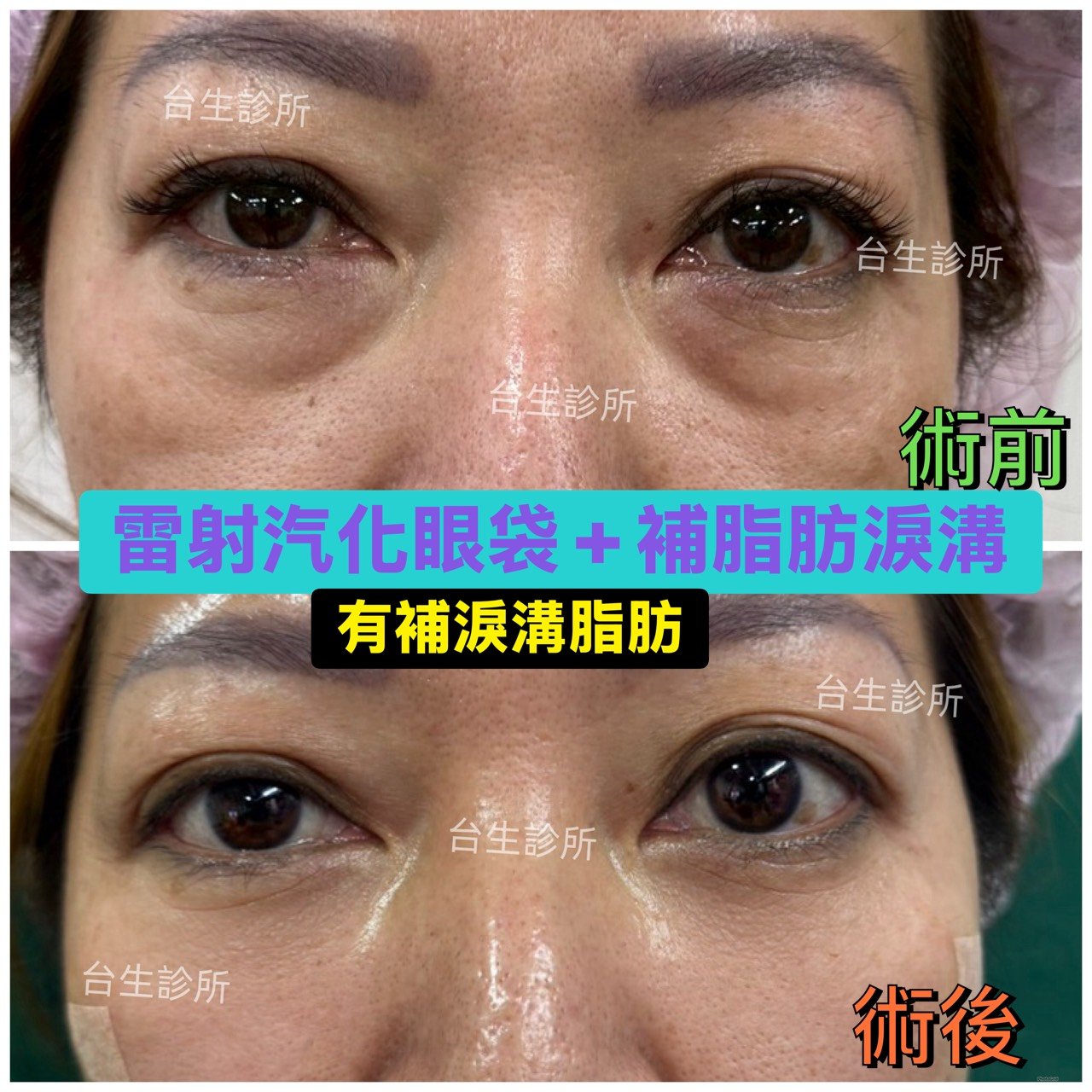 術後成果~30分鐘雷射汽化眼袋+自體脂肪填補淚溝黑眼圈 - 