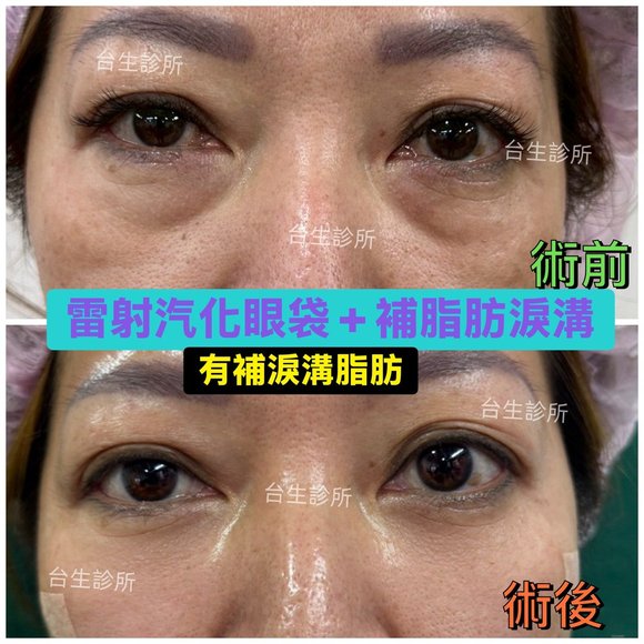術後成果~30分鐘雷射汽化眼袋+自體脂肪填補淚溝黑眼圈 - 