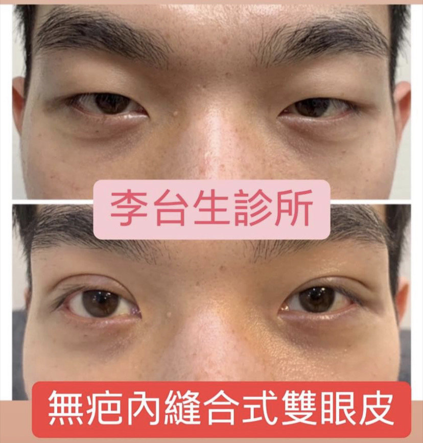 縫合式雙眼皮 - 