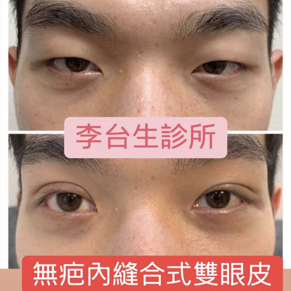 縫合式雙眼皮 -
