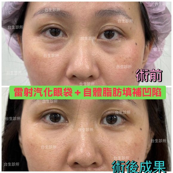 術後成果~30分鐘雷射汽化眼袋+自體脂肪填補淚溝黑眼圈 - 