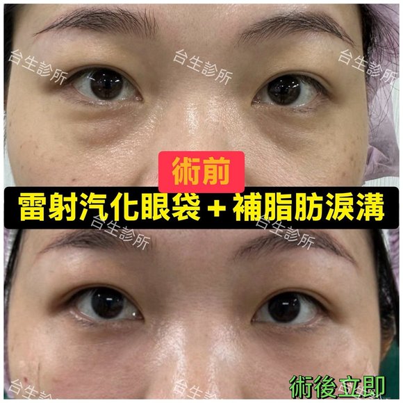 術後成果~30分鐘雷射汽化眼袋+自體脂肪填補淚溝黑眼圈 - 