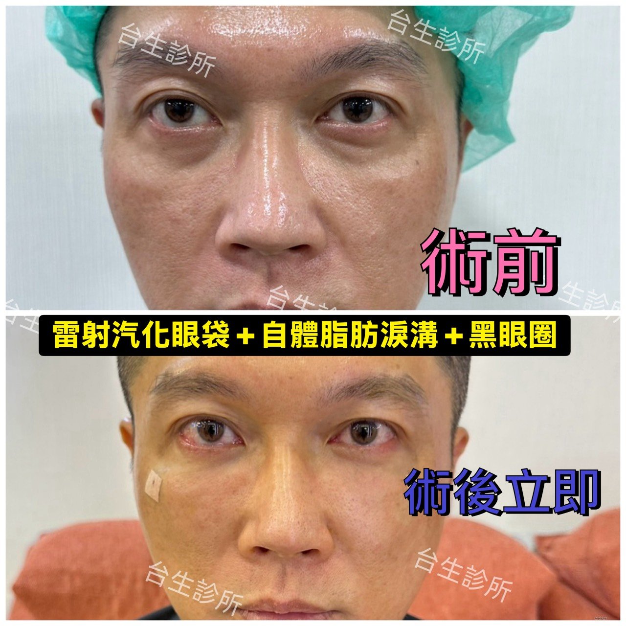[內有影片]: 術後立即效果~30分鐘雷射汽化眼袋+自體脂肪填補淚溝黑眼圈 - 