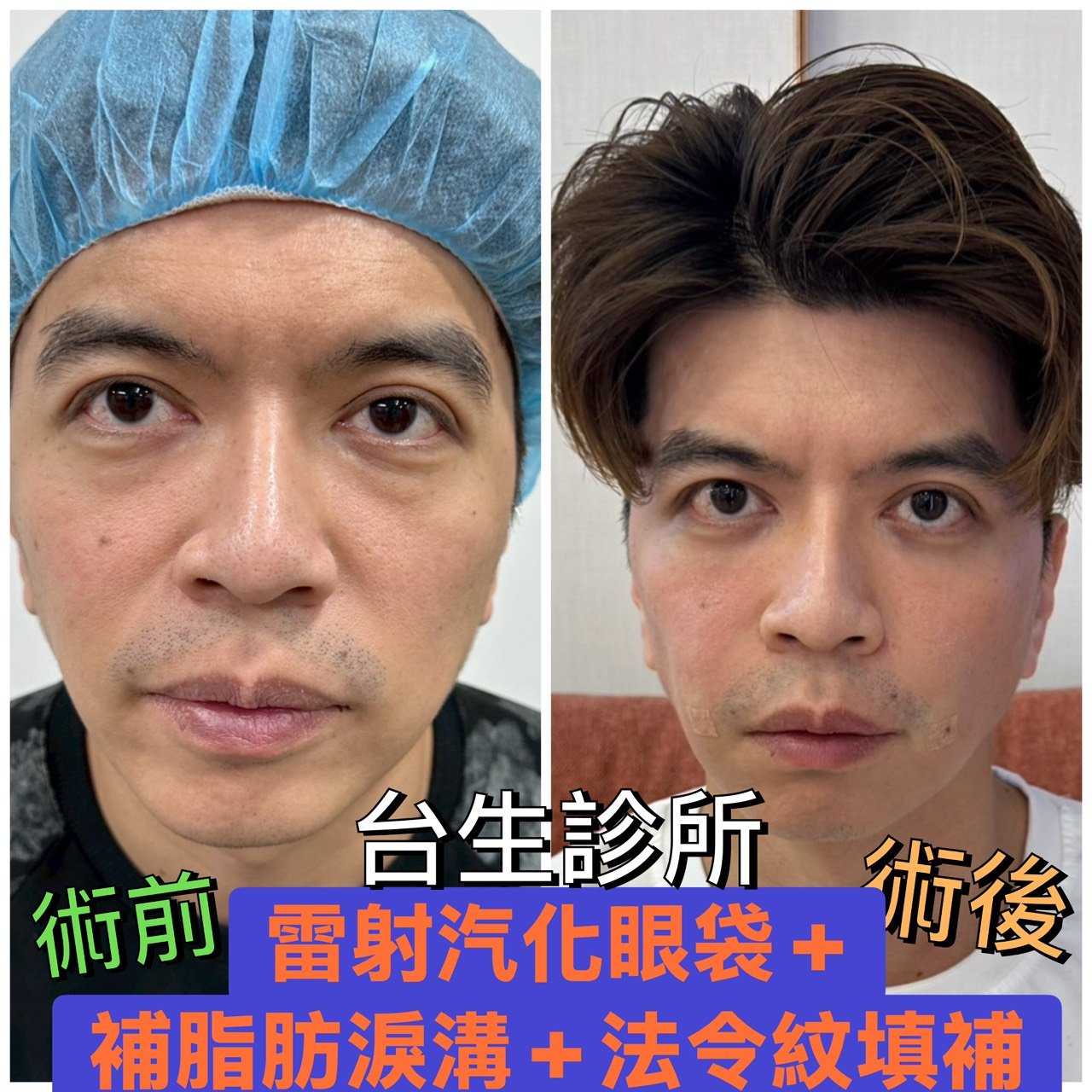 30分鐘雷射汽化眼袋+自體脂肪填補淚溝+法令紋填補~術後效果呈現 - 