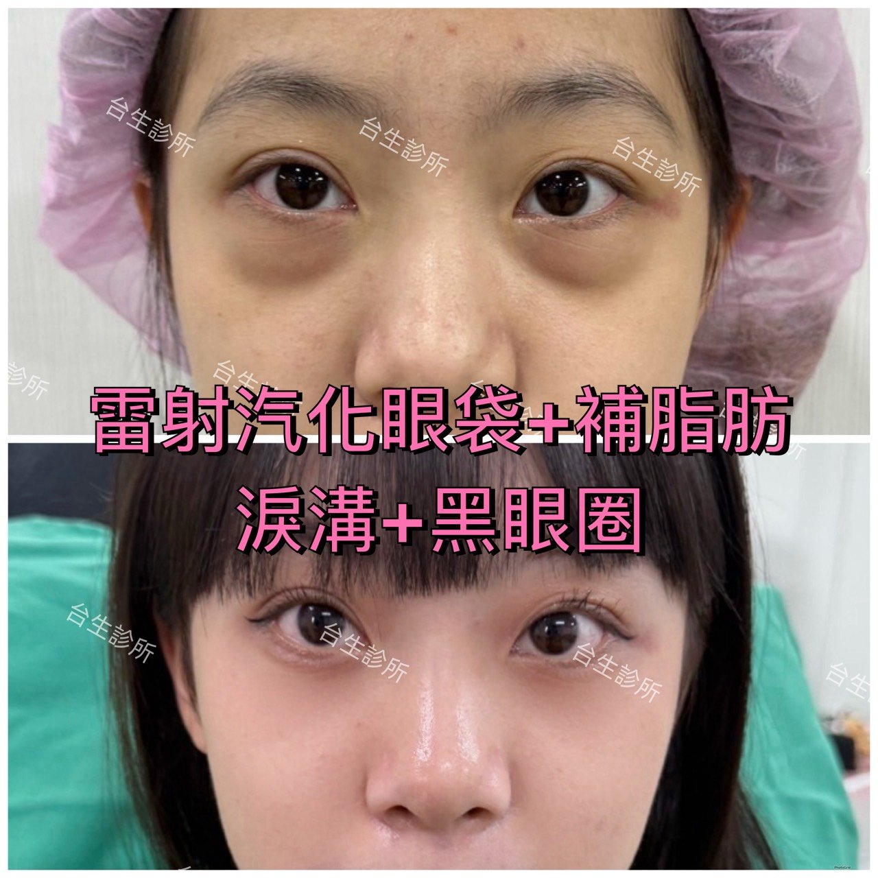 術後成果~30分鐘雷射汽化眼袋+自體脂肪填補淚溝黑眼圈 - 