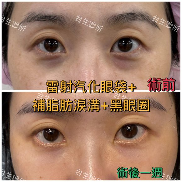 術後一週效果~30分鐘雷射汽化眼袋+自體脂肪填補淚溝黑眼圈 - 