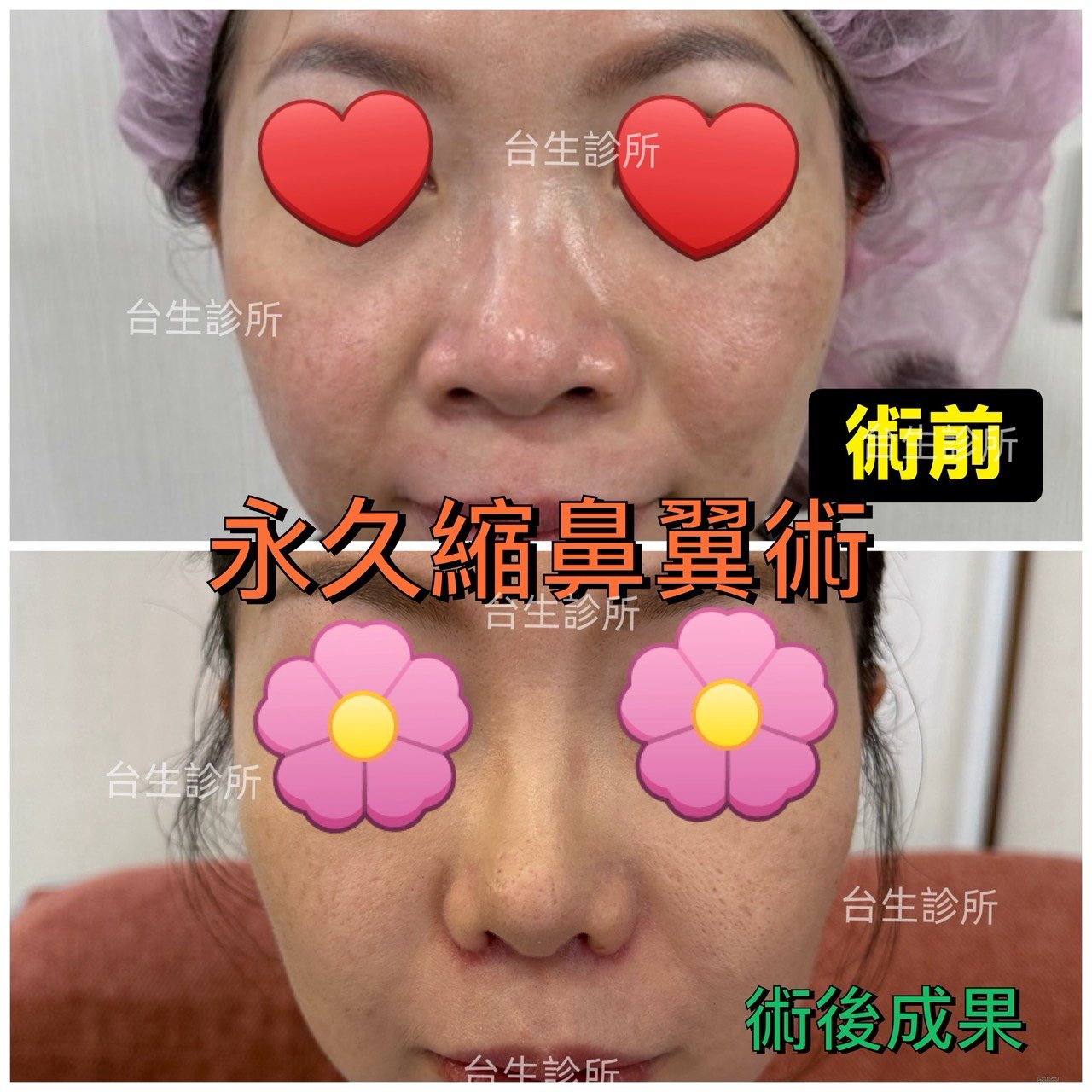 創造魅力五官~ 30分鐘微創永久精緻縮鼻翼術 - 