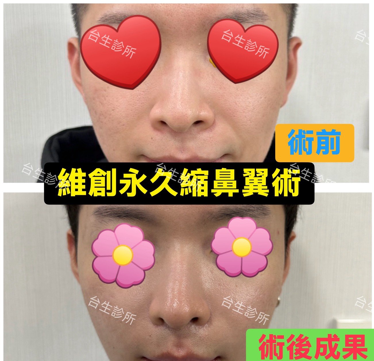 擺脫大笑外擴感~ 30分鐘微創永久精緻縮鼻翼術 - 