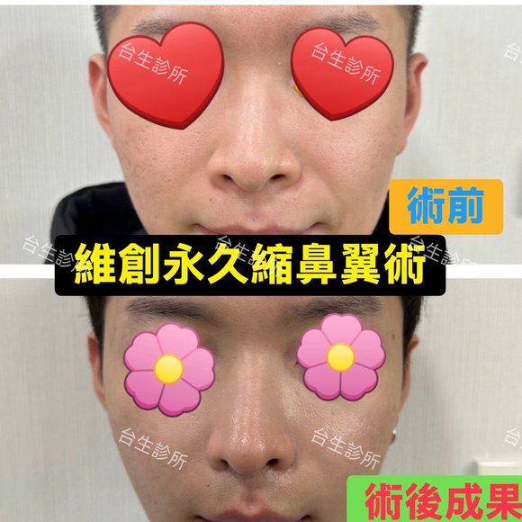 擺脫大笑外擴感~ 30分鐘微創永久精緻縮鼻翼術 - 