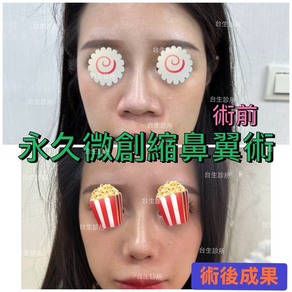 創造魅力五官~ 30分鐘微創永久精緻縮鼻翼術 - 