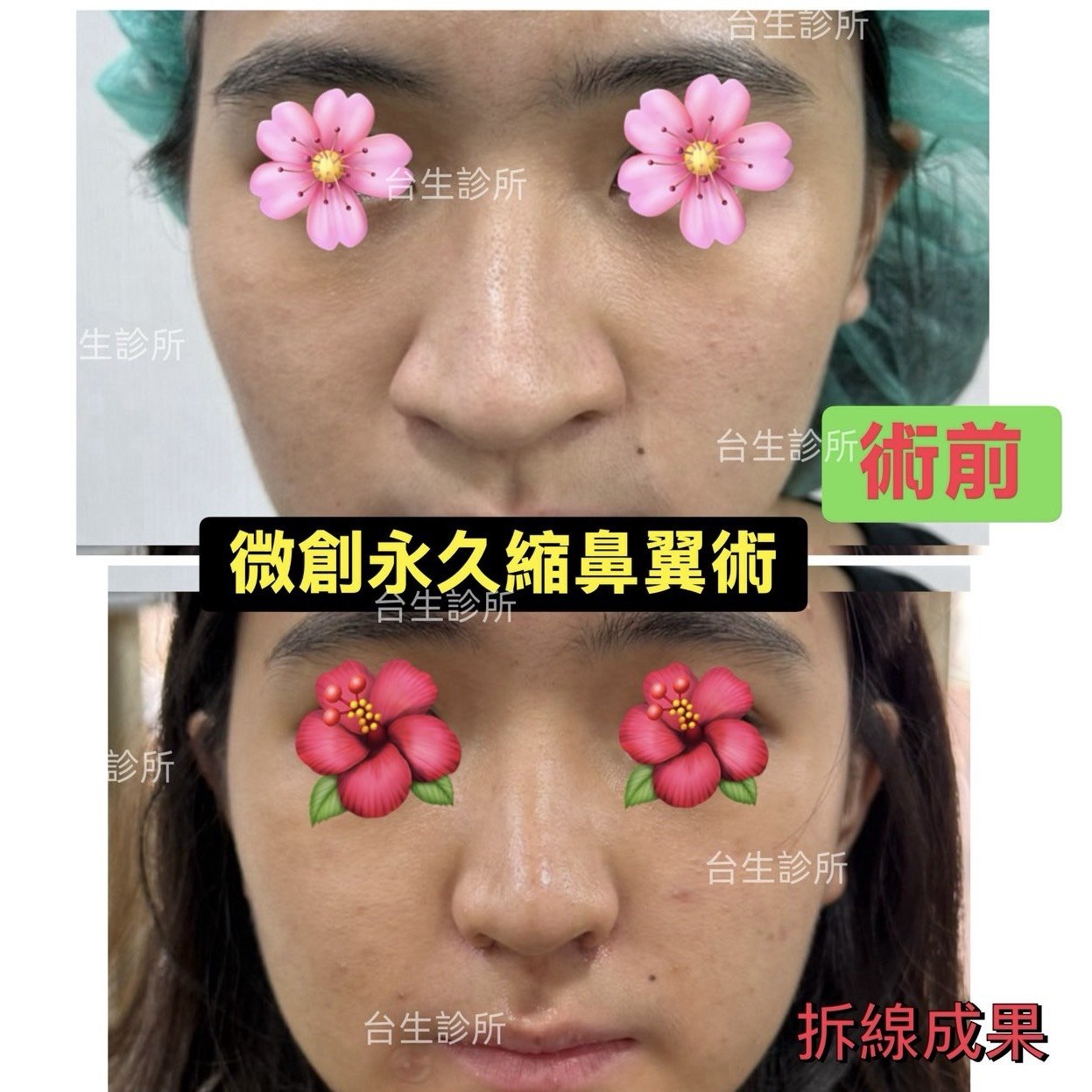 30分鐘微創永久縮鼻翼術後拆線效果 - 