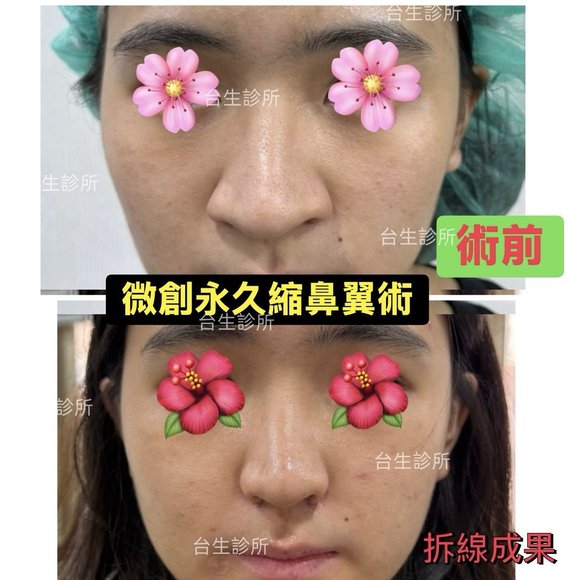 30分鐘微創永久縮鼻翼術後拆線效果 - 