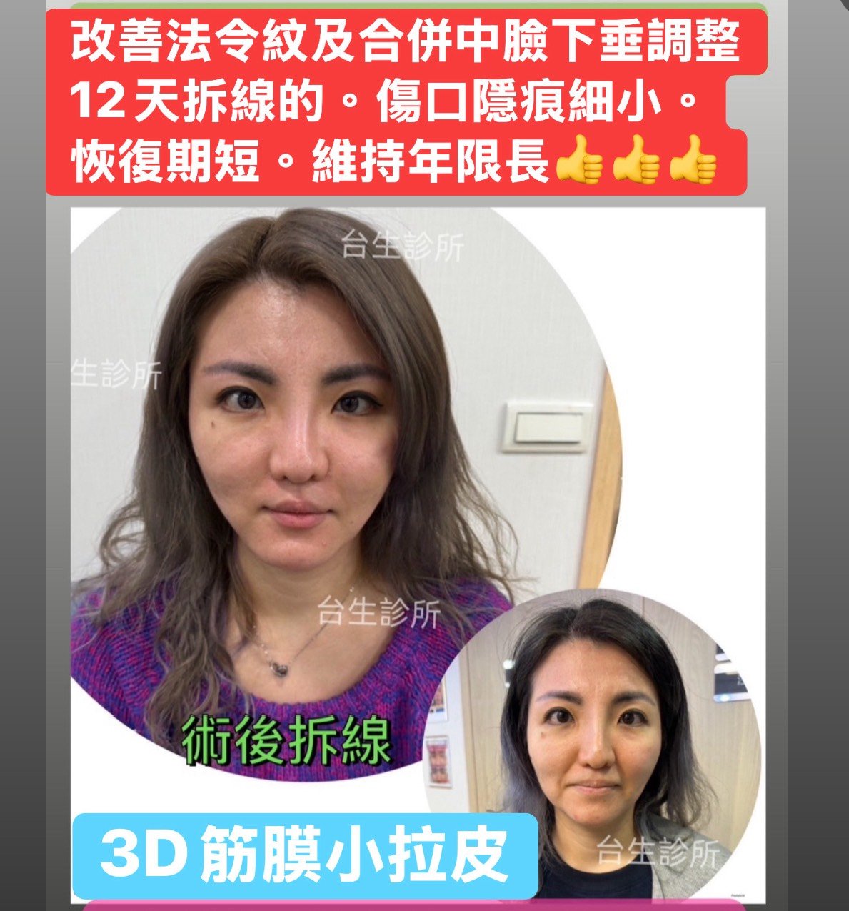  [內有影片]:  改善法令紋及合併中臉下垂調整12天拆線的 - 