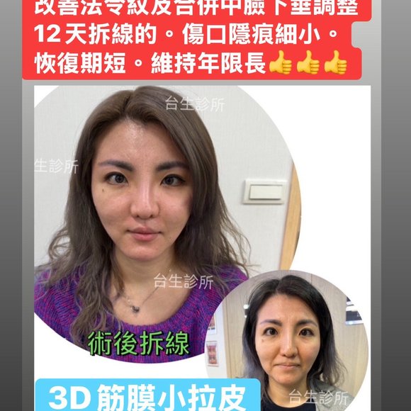  [內有影片]:  改善法令紋及合併中臉下垂調整12天拆線的 - 